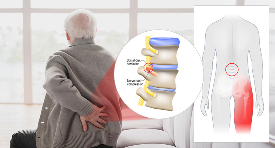 Elderly person with sciatica