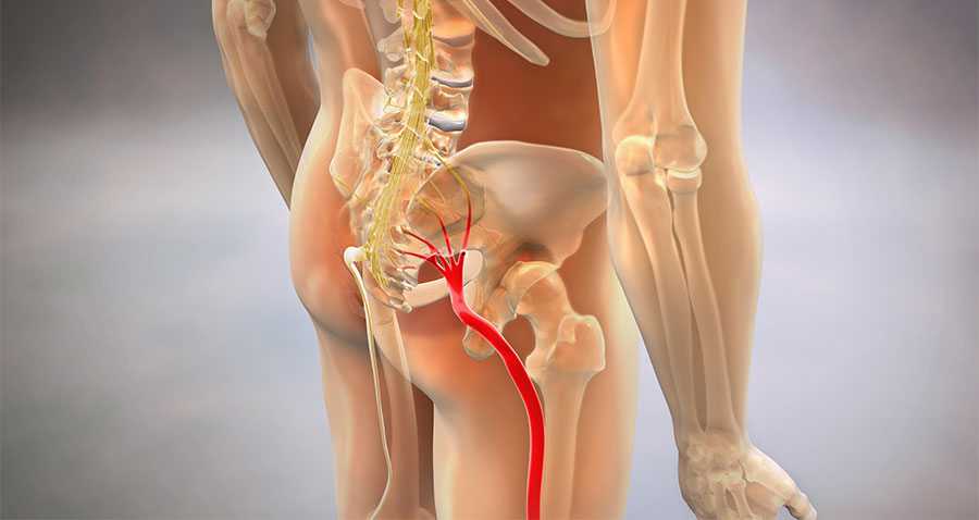 Sciatica pain relief